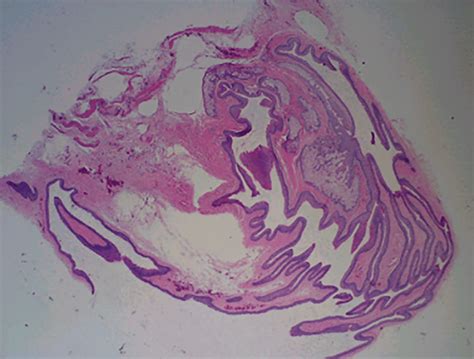 Histology Of Steatocystoma Crenulated Keratin Lining The Cyst With