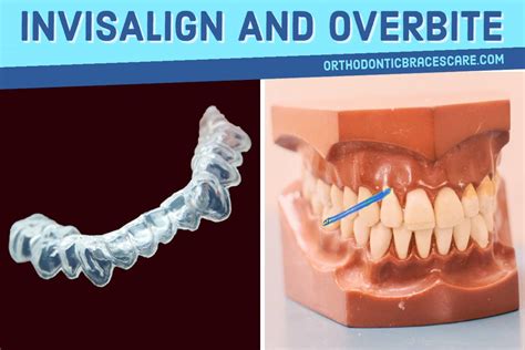 We did not find results for: Can Invisalign Really Fix An Overbite | Orthodontic Braces ...