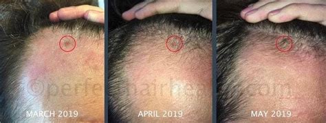 Rosemary Oil For Hair Loss Not So Fast See Photos Evidence