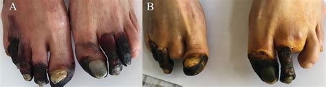 Rheumatoid Vasculitisassociated Foot Gangrene The Journal Of