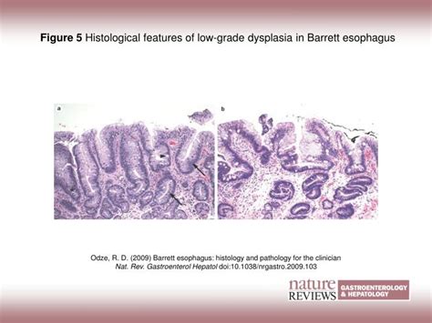 PPT Figure 5 Histological Features Of Low Grade Dysplasia In Barrett