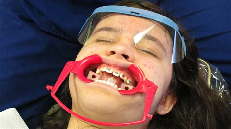 getting braces on youtube