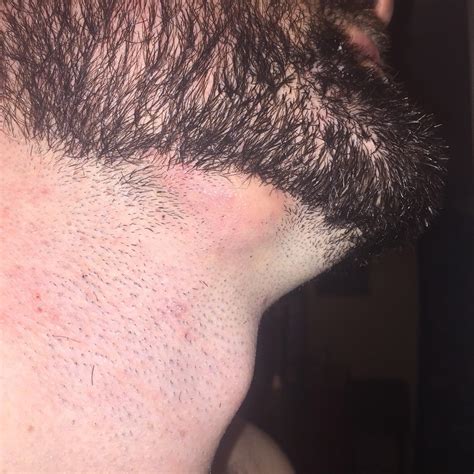 Skin Concern These Large Abscesses Form On My Boyfriends Face And