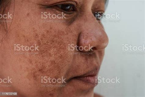 Skin Problem Closeup Skin Face Asian Women With Spot Melasma Stock