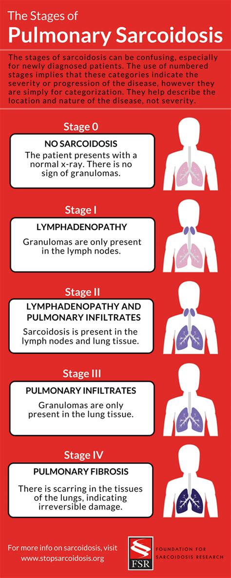 Sarcoidosis Causes Stage Signs Symptoms Diagnosis And Treatment