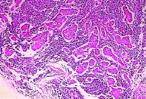 Histopathology Of Excised Cervical Lymph Node Showing Reactive