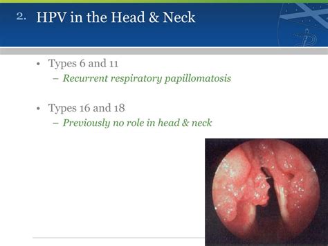 Ppt Hpv Associated Oropharyngeal Cancer Powerpoint Presentation Free