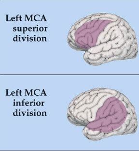 Brain Injury Deficits CVAs Flashcards Quizlet
