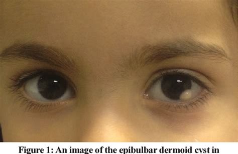 Epibulbar Dermoid Cyst In A Patient With Vacterl Association Semantic