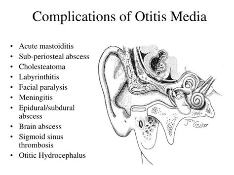 Ppt Chronic Otitis Media And Complications Powerpoint Presentation