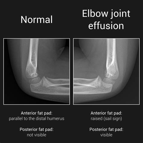 Elbow Joint Effusion Sail Sign Pacs