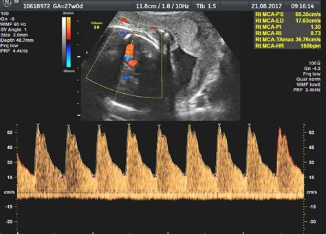 Example Of Fetal Middle Cerebral Artery Mca Doppler With A Good Image