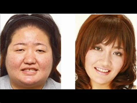 Plastic Surgery In Japan Youtube Hot Sex Picture