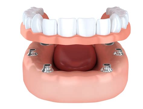 Proteza Dentara Pe Implanturi Tipuri Caracteristici Miko Dental
