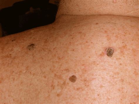 Seborrheic Keratosis Pictures Symptoms Treatment Removal And