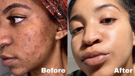 How To Get Rid Of Acne And Dark Spots Fast My Acne Journey Photos