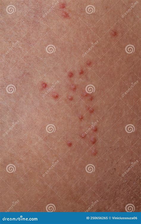 Allergic Reactions To Tick Bites Stock Image Image Of Ixodida