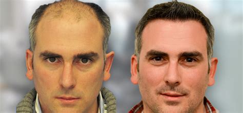 Doctors have been doing these transplants in the u.s. Fue Hair Transplant Before And After