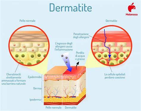 Dermatite cosè tipologie principali cause sintomi cura e trattamento