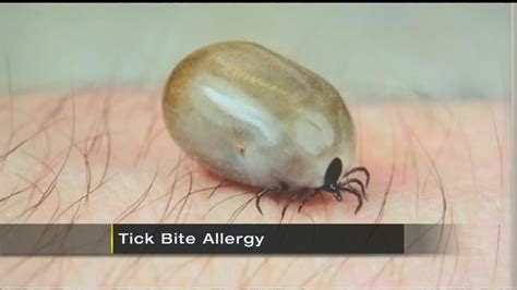 Tick Borne Illness Can Cause Allergy To Red Meat Wpxi