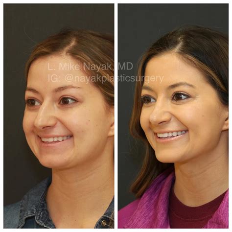 Chin Implants Before And After Patient 02 Nayak Plastic Surgery