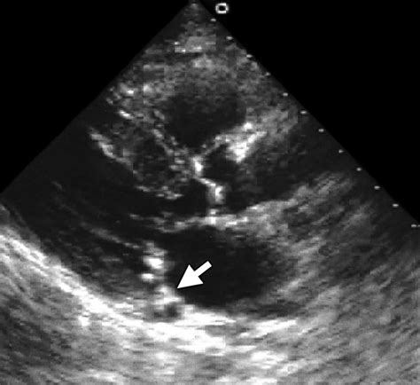 Mitral Annular Calcification Mac Blog Ecope