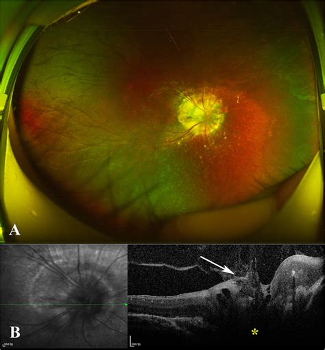 A Widefield Color Fundus Photograph Of The Right Eye Revealed A