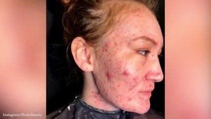 Girl With Bad Acne