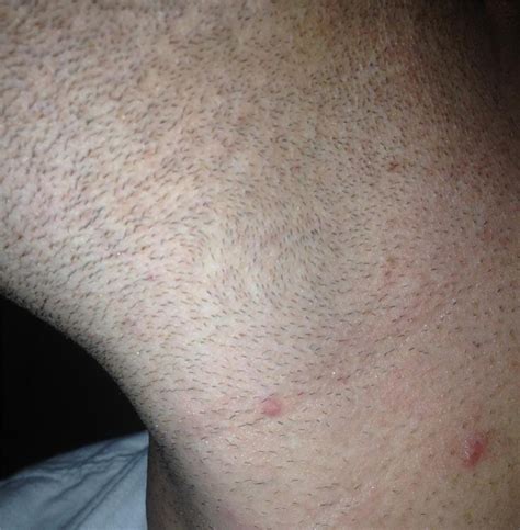 Are These Ingrowns Folliculitis Pseudo Folliculitis Pimples Help