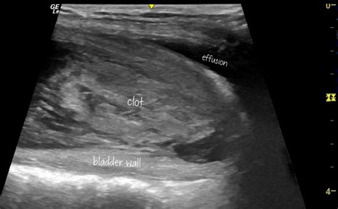 Sonographic Manifestations Of Bleeding Disorders In Dogs Including A