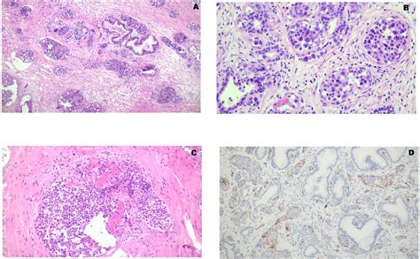 Intravascular Large B Cell Lymphoma Pathological Features A The