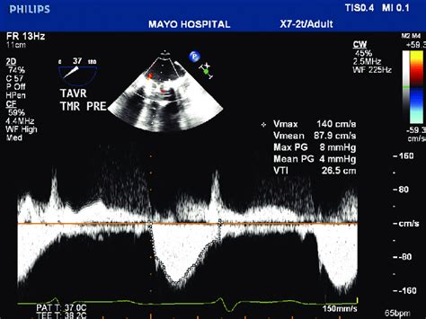 Continuous Wave Doppler Of Mitral Inflow Illustrating Low Gradient In