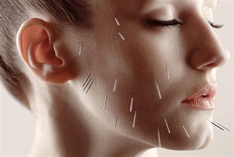 Cosmetic Acupuncture And Micro Needling Cape Fear Community Acupuncture