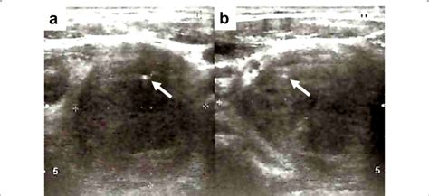 Preoperative Thyroid Sonography Ultrasound Revealed A Large Hypoechoic