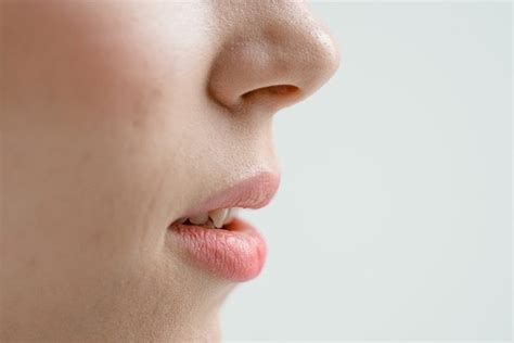 Banish Cracked Lip Corners For Kissable Lips Cv Skinlabs