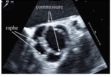 Two Dimensional Transesophageal Echocardiographic Image Of The Aortic