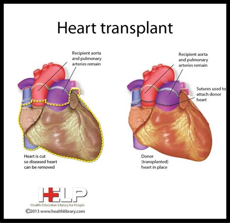 Heart Transplant Easy Way To See How Its Sutured In Yes I Love