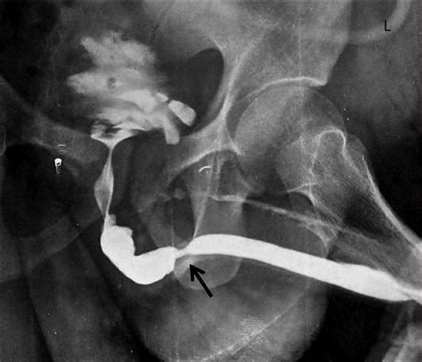 Retrograde Urethrogram Showing Bulbar Urethral Stricture Case