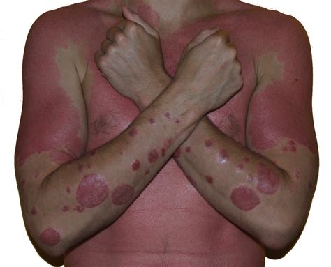 Dont Sweat The Small Spots A Warrior Curing Psoriasis Naturally