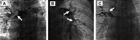 Pulmonary Angiography Shows Massive Pulmonary Embolism Over The A