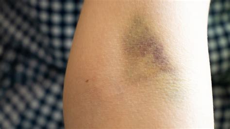 Bruising On Arm After Blood Draw Draw Hke