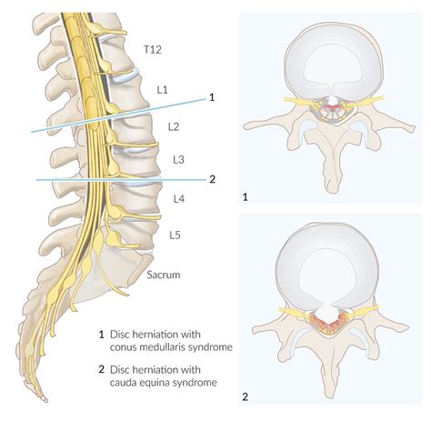 Cone Medullaris V Cauda Equina Symmetry Of Pain