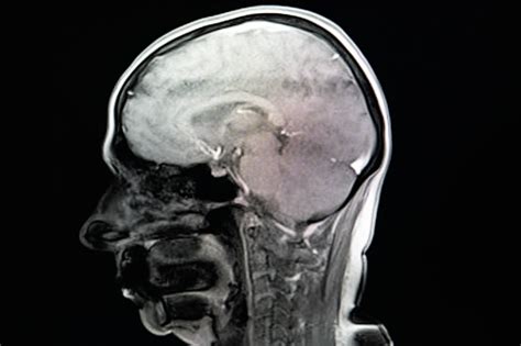 Brain Mri Scan Scanning Of Brains Magnetic Resonance Image Diagnostic