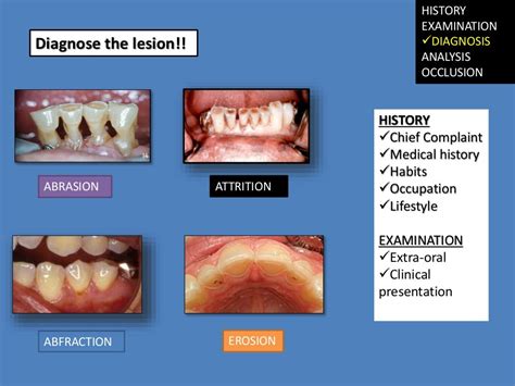 2diagnosis Restoration Of Worn Dentition
