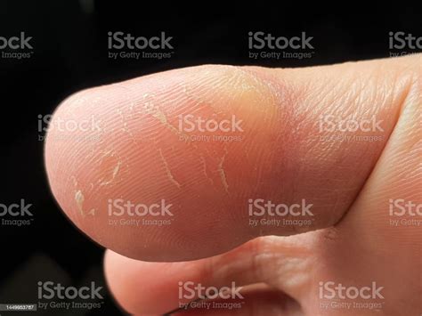 Calluses Or Hyperkeratosis Are Caused By Excessive And Repeated