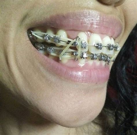 Braces Girlswithbraces Metalbraces Elastics Dental Braces Metal
