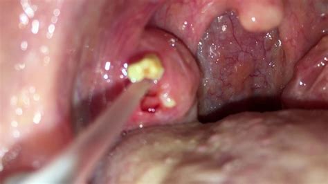 Tonsil Stones Tonsil Stone Tonsillolith Removal Big And Bigger Youtube