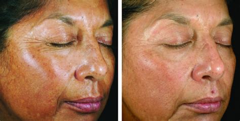 Chemical Peels In Milwaukee Fine Lines And Wrinkles Evolvmd