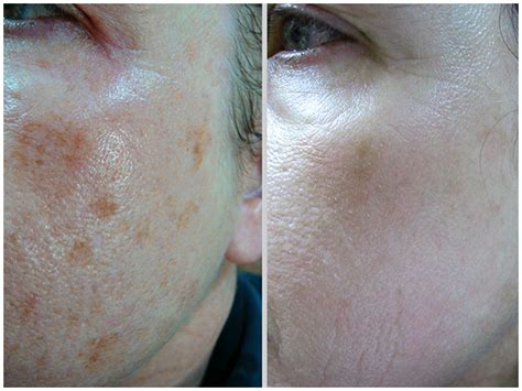 Bbl Photofacial Skin Rejuvenation At Pynch Anti Aging And Med Spa Services