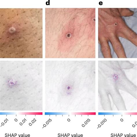 PDF A Deep Learning Algorithm To Classify Skin Lesions From Mpox